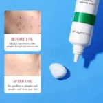 Bioaqua Salicylic Acid Cream Acne Removal - 20g