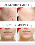 Sadoer Aha Fruit Acid Acne Repair Serum - 30ml - Divax.pk